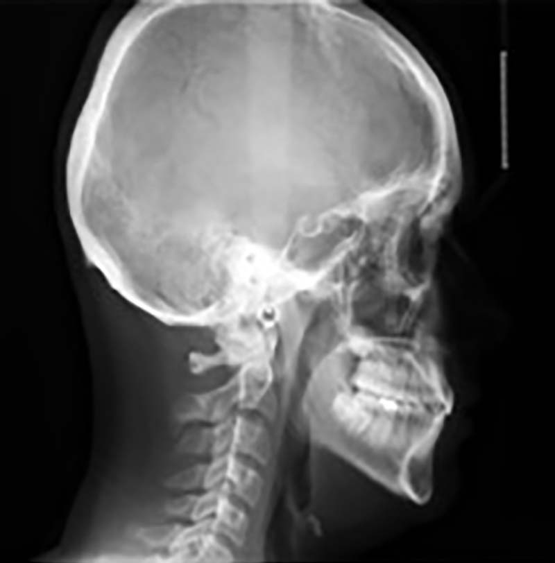 cephalometric x-ray