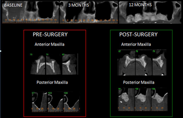 bone grafting case