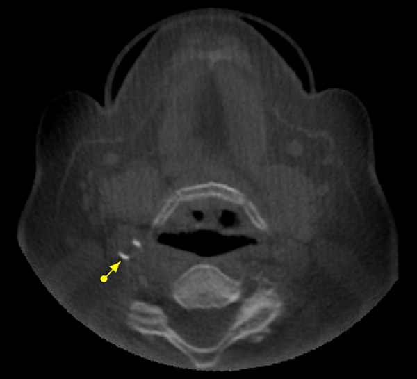 carotid space calcification