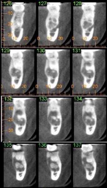 lesion cross sections