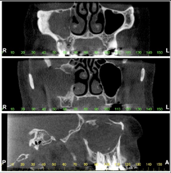 sinus pathology