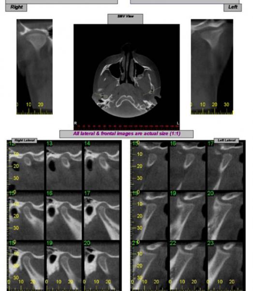 
temporomandibular joints