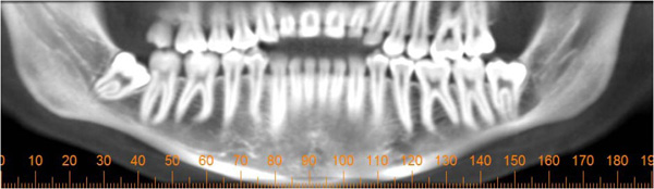 extraction of impacted tooth