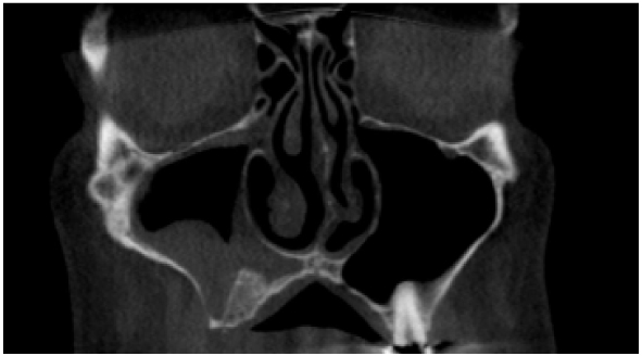 maxillary sinus