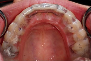 Occlusal bite splint