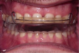 Occlusal bite splint