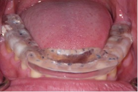 Occlusal bite splint