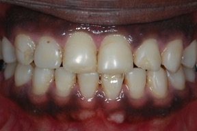 Ceramic veneers