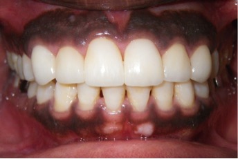 Ceramic veneers