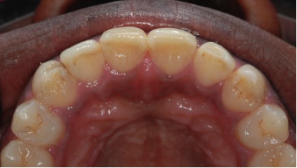 Ceramic veneers