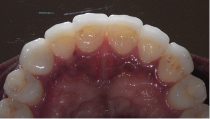 Ceramic veneers