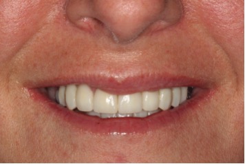 after pic of replacing teeth