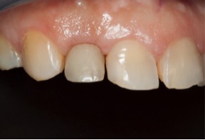 before pic of dental implant