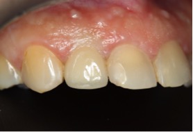 before pic of dental implant