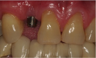 during pic of dental implant