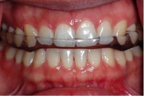 Occlusal bite splint