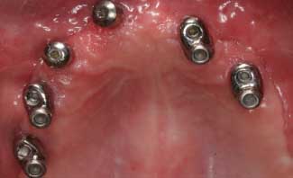 before pic of replacing teeth