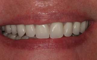 after pic of replacing teeth