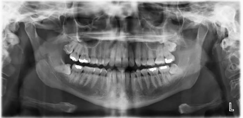 panoramic x-ray