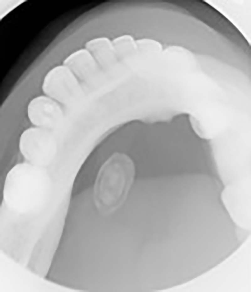 occlusal x-ray