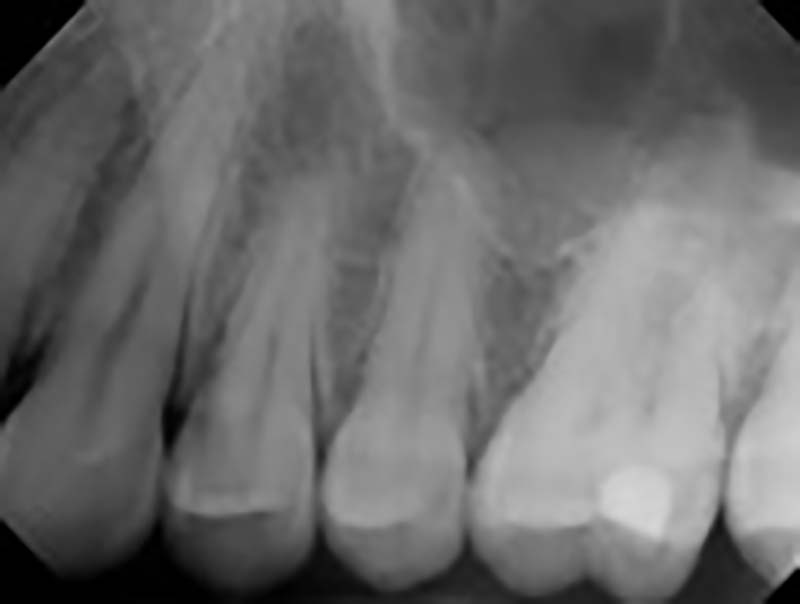 periapical x-ray